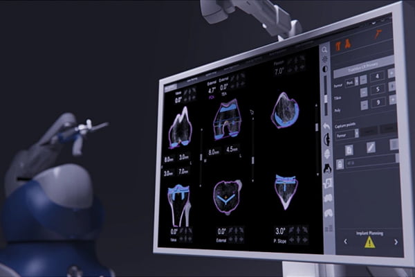 MAKO Robotic Surgery Dr. Robert Ference