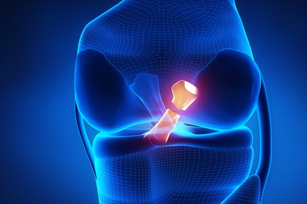 Torn-Meniscus Surgery - Dr. Robert Ference MD (Michigan and Ohio)