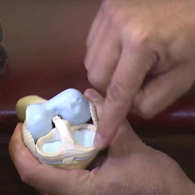 Is a Partial Knee Replacement Right for You?